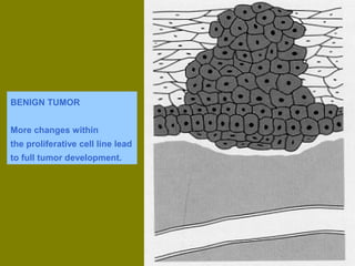 BENIGN TUMOR 
More changes within 
the proliferative cell line lead 
to full tumor development. 
 