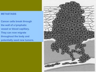 METASTASIS 
Cancer cells break through 
the wall of a lymphatic 
vessel or blood capillary. 
They can now migrate 
throughout the body and 
potentially seed new tumors. 
 