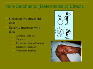 Non-Stochastic (Deterministic) Effects 
 Occurs above threshold 
dose 
 Severity increases with 
dose 
 Alopecia (hair loss) 
 Cataracts 
 Erythema (skin reddening) 
 Radiation Sickness 
 Temporary Sterility 
 