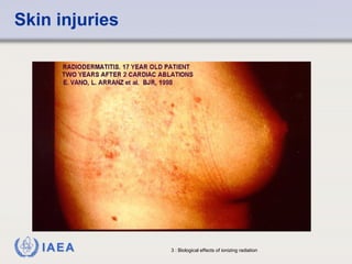 Skin injuries 
IAEA 3 : Biological effects of ionizing radiation 
 