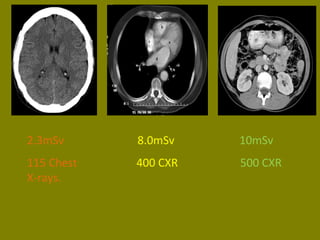 2.3mSv 8.0mSv 10mSv 
115 Chest 400 CXR 500 CXR 
X-rays. 
 