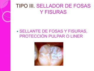TIPO III. SELLADOR DE FOSAS
Y FISURAS
 SELLANTE DE FOSAS Y FISURAS,
PROTECCIÓN PULPAR O LINER
 