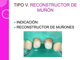 TIPO V. RECONSTRUCTOR DE
MUÑÓN
 INDICACIÓN:
 RECONSTRUCTOR DE MUÑONES
 