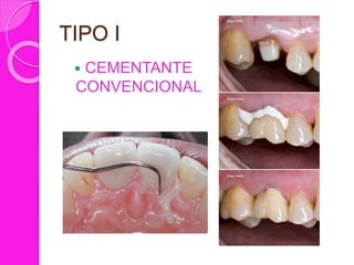 TIPO I
 CEMENTANTE
CONVENCIONAL
 