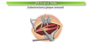 IONM for Carotid Surgery & Carotidendartectomy | PPTX