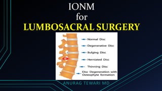 IONM
for
LUMBOSACRAL SURGERY
ANURAG TEWARI MD
 