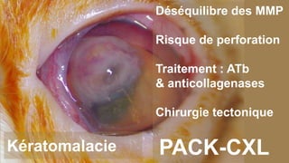 Kératomalacie 
Déséquilibre des MMP 
Risque de perforation 
Traitement : ATb 
& anticollagenases 
Chirurgie tectonique 
PACK-CXL 
 