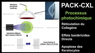 PACK-CXL 
Processus 
photochimique 
Réticulation du 
Collagène 
Effets bactéricides 
Directs 
Apoptose des 
Keratocytes 
 