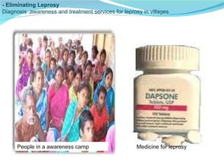 . - Eliminating Leprosy Diagnosis ,awareness and treatment services for leprosy in villages People in a awareness camp Medicine for leprosy 