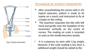 Fig 6. Schiotz tonometer
TECHNIQUE OF SCHIOTZ TONOMETRY
 After anaesthetising the cornea with 2–4%
topical xylocaine, patient is made to lie
supine on a couch and instructed to fix at
a target on the ceiling.
 The examiner separates the lids with left
hand and gently rests the footplate of the
tonometer vertically on the centre of
cornea. The reading on scale is recorded
as soon as the needle becomes steady.
• It is customary to start with 5.5g weight.
However, if the scale reading is less than 3,
additional weight should be added to the
 