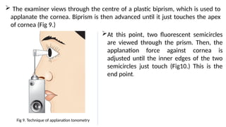  The examiner views through the centre of a plastic biprism, which is used to
applanate the cornea. Biprism is then advanced until it just touches the apex
of cornea (Fig 9.)
Fig 9. Technique of applanation tonometry
At this point, two fluorescent semicircles
are viewed through the prism. Then, the
applanation force against cornea is
adjusted until the inner edges of the two
semicircles just touch (Fig10.) This is the
end point.
 