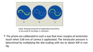 Fig10. Showing end point of applanation tonometry
A, too small; B, too large; C, end point.
 The prisms are caliberated in such a way that inner margins of semicircles
touch when 3.06 mm of cornea is applanated. The intraocular pressure is
determined by multiplying the dial reading with ten to obtain IOP in mm
Hg.
 