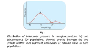 Fig 1.
Distribution of intraocular pressure in non-glaucomatous (N) and
glaucomatous (Q) populations, showing overlap between the two
groups (dotted lines represent uncertainty of extreme value in both
populations.
 