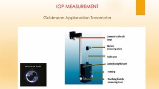 IOP MEASUREMENT
Goldmann Applanation Tonometer
 