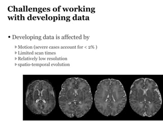 Challenges of working
with developing data
• Developing data is affected by
Motion (severe cases account for < 2% )
Limite...