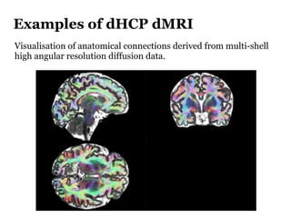 Examples of dHCP dMRI
Visualisation of anatomical connections derived from multi-shell
high angular resolution diffusion d...