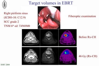 Target volumes in EBRT Before Rx-CH 46 Gy (Rx-CH) Right piriform sinus (ICDO-10: C12.9) SCC grade 2 TNM 6 th  ed: T4N0M0 Fiberoptic examination CT MRI T2 FS FDG-PET 