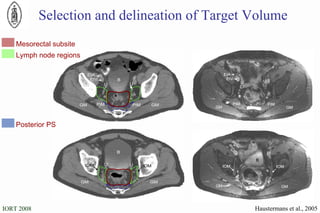 Mesorectal subsite Lymph node regions Posterior PS Selection and delineation of Target Volume Haustermans et al., 2005 