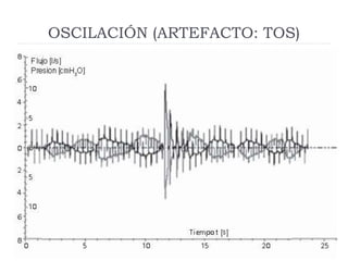 OSCILACIÓN (ARTEFACTO: TOS)
 