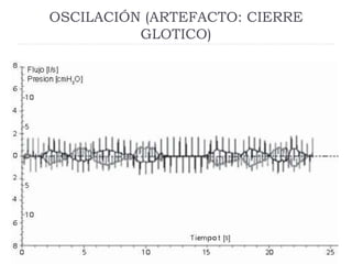 OSCILACIÓN (ARTEFACTO: CIERRE
GLOTICO)
 