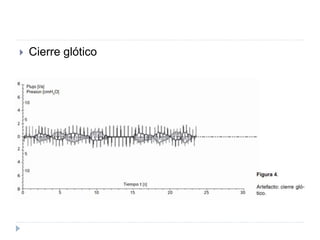  Cierre glótico
 