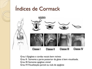 Índices de Cormack




  Grau I: Epiglote e cordas vocais bem visíveis
  Grau II: Somente a parte posterior da glote é bem visualizada.
  Grau III: Somente epiglote visível
  Grau IV: Visualização parcial ou nula da epiglote
 