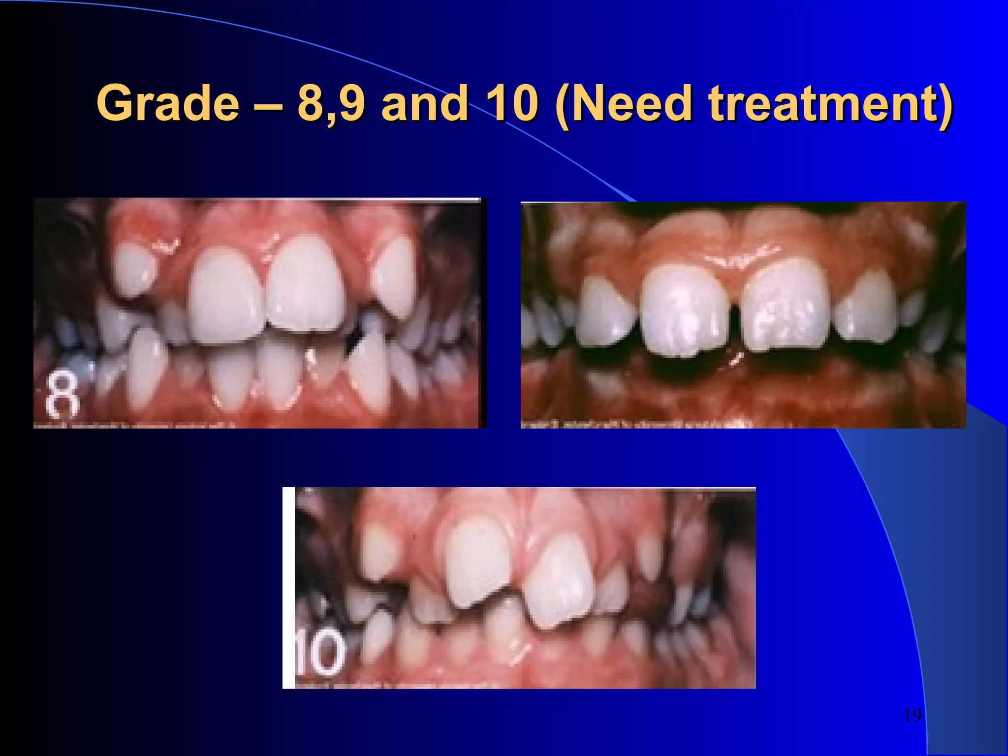 Index of Orthodontic Treatment Need (IOTN) PPT