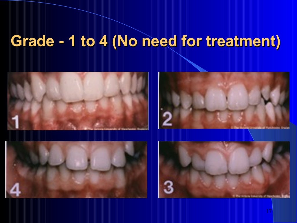 Index of Orthodontic Treatment Need (IOTN)