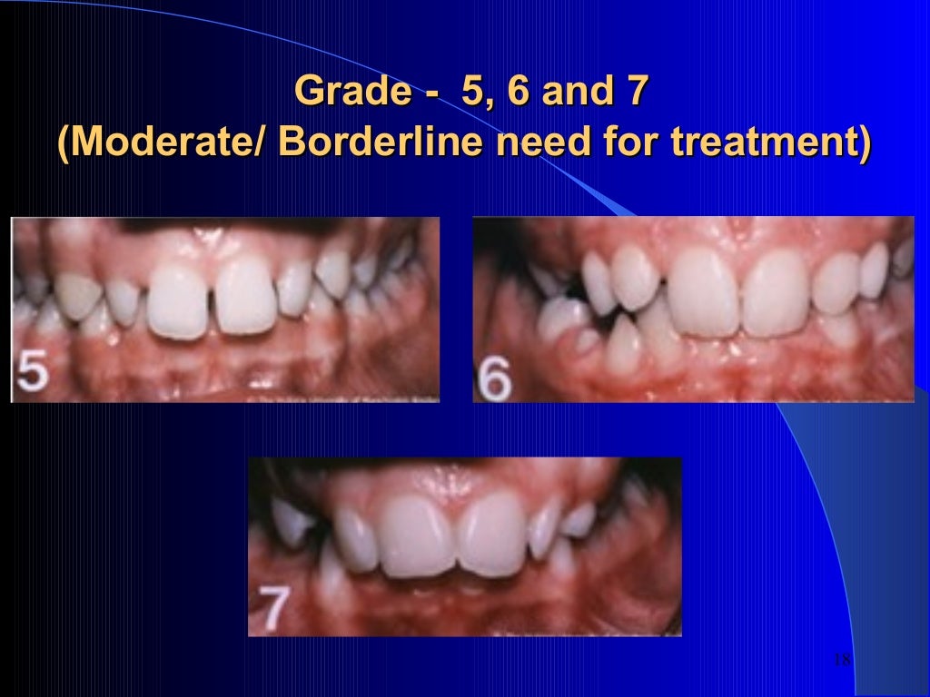 Index of Orthodontic Treatment Need (IOTN)