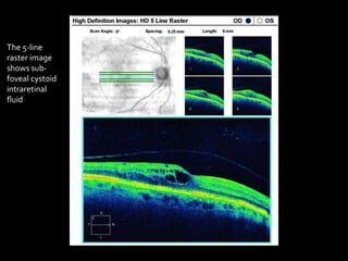 Mac 5 Line Raster Diabetic Retinopathy: A Clinical Survival Guide | PPTX