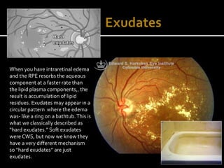 Fluid Under Rpe Diabetic Retinopathy: A Clinical Survival Guide | PPTX