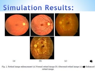 Automatic Blood Vessels Segmentation of Retinal Images | PPTX