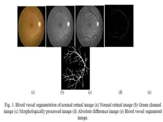 Automatic Blood Vessels Segmentation of Retinal Images | PPTX