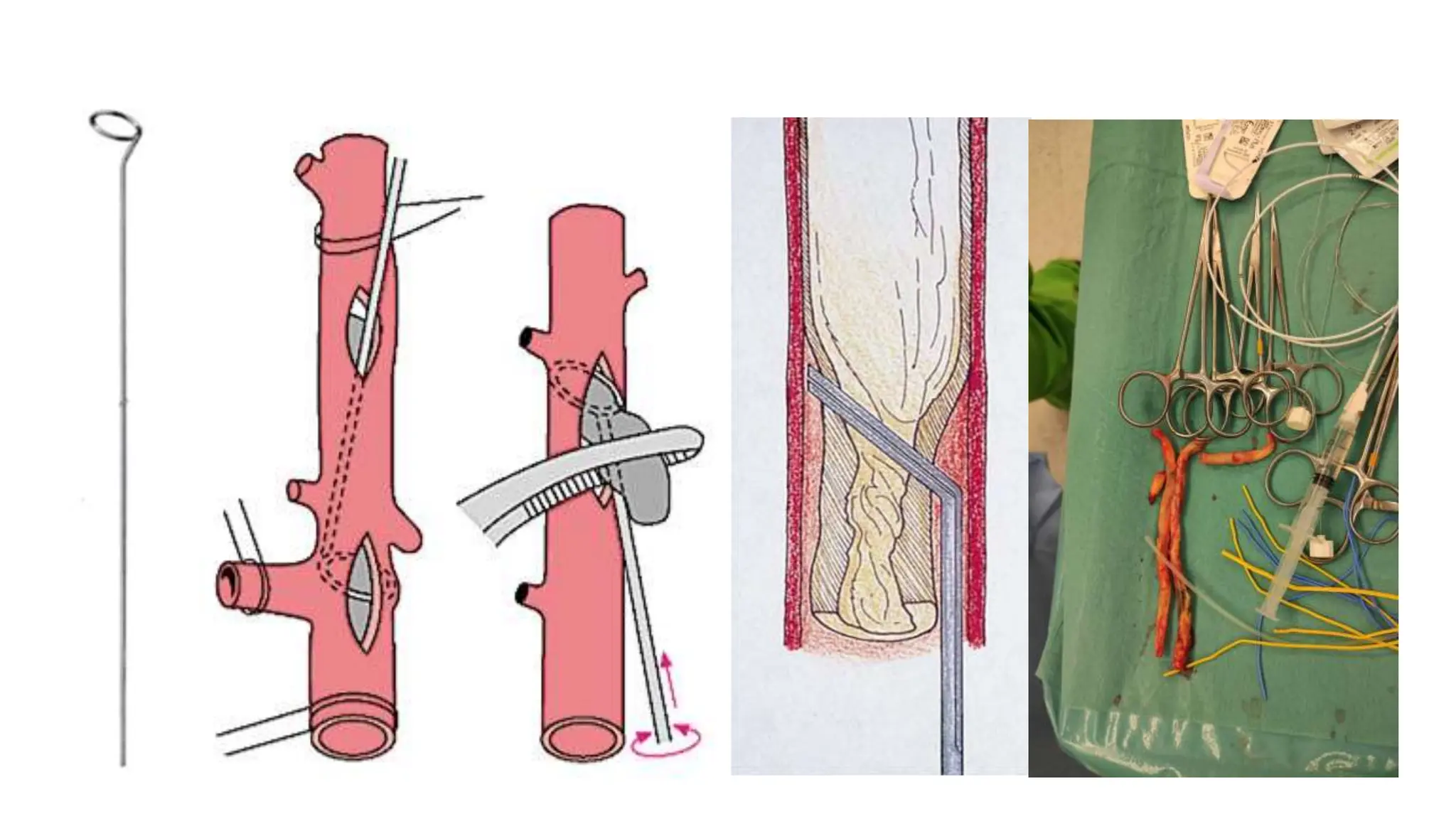 Diagnosis and treatment of lower extremity vascular diseases | PPTX