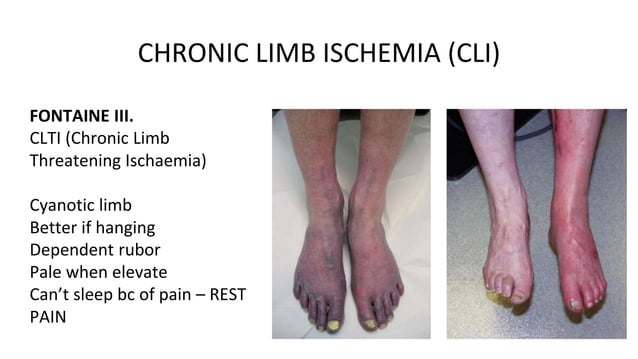 Diagnosis and treatment of lower extremity vascular diseases | PPTX