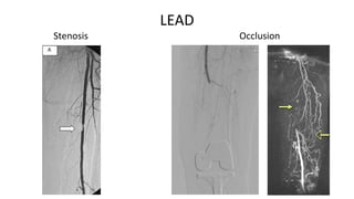 Diagnosis and treatment of lower extremity vascular diseases | PPTX