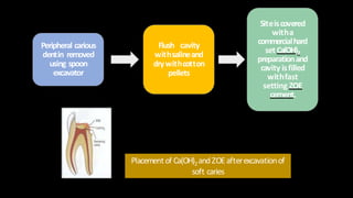 Placementof Ca(OH)2andZOEafterexcavationof
soft caries
Peripheral carious
dentin removed
using spoon
excavator
Flush cavity
withsalineand
drywithcotton
pellets
Siteiscovered
witha
commercialhard
setCa(OH)2
preparationand
cavity isfilled
withfast
setting ZOE
cement.
 
