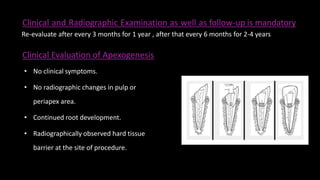 Clinical and Radiographic Examination as well as follow-up is mandatory
Clinical Evaluation of Apexogenesis
• No clinical symptoms.
• No radiographic changes in pulp or
periapex area.
• Continued root development.
• Radiographically observed hard tissue
barrier at the site of procedure.
Re-evaluate after every 3 months for 1 year , after that every 6 months for 2-4 years
 