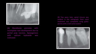 (A) Mandibular premolar with
incomplete root development due to
partial pulp necrosis. Apexogenesis
with calcium hydroxide was
instituted.
(B) Two years later, apical closure was
evident in the radiograph. Root canal
treatment was completed using gutta-
percha with a root canal sealant
 