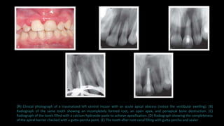 (A) Clinical photograph of a traumatized left central incisor with an acute apical abscess (notice the vestibular swelling). (B)
Radiograph of the same tooth showing an incompletely formed root, an open apex, and periapical bone destruction. (C)
Radiograph of the tooth filled with a calcium hydroxide paste to achieve apexification. (D) Radiograph showing the completeness
of the apical barrier checked with a gutta-percha point. (E) The tooth after root canal filling with gutta-percha and sealer
 
