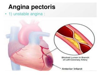 angina pectoris