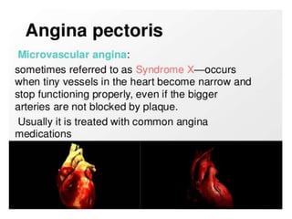 angina pectoris
