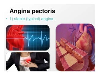 angina pectoris