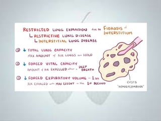 Шалтгаан тодорхойгүй уушгины фиброз өвчин | PPT