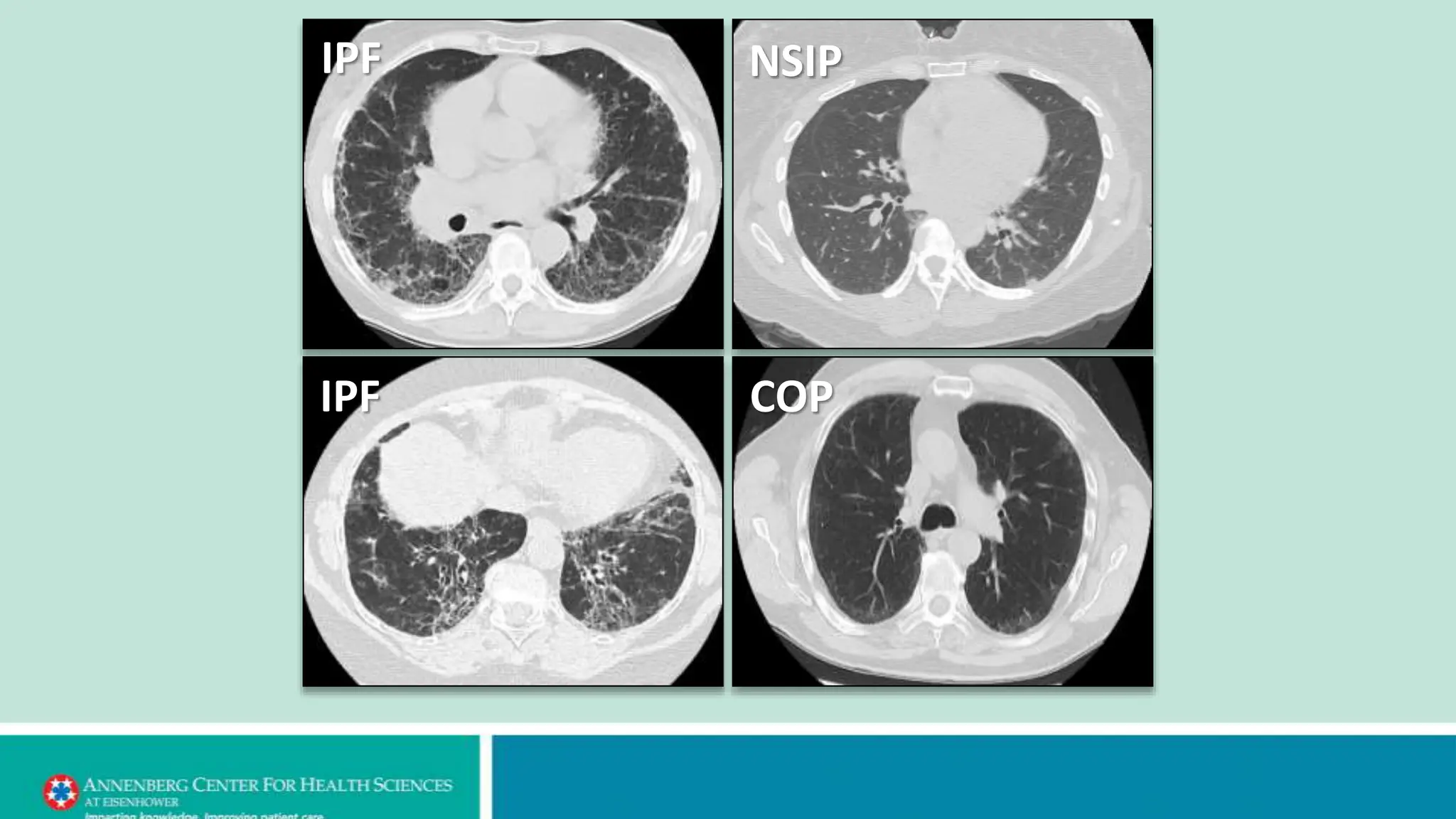 Ipf Image Idiopathic Pulmonary Fibrosis powerpoint.pptx