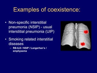 Examples of coexistence:
• Non-specific interstitial
pneumonia (NSIP) - usual
interstitial pneumonia (UIP)
• Smoking related interstitial
diseases
– RB-ILD / NSIP / Langerhan’s /
emphysema

2

1

 
