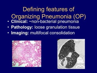 Defining features of
Organizing Pneumonia (OP)

• Clinical: ~non-bacterial pneumonia
• Pathology: loose granulation tissue
• Imaging: multifocal consolidation

 