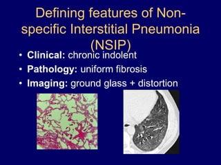 Defining features of Nonspecific Interstitial Pneumonia
(NSIP)

• Clinical: chronic indolent
• Pathology: uniform fibrosis
• Imaging: ground glass + distortion

 
