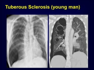 Tuberous Sclerosis (young man)

 