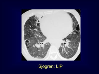 Sjögren: LIP

 